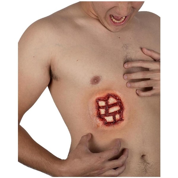 Rib Injury FX Appliance Transfer Prosthetic Wound